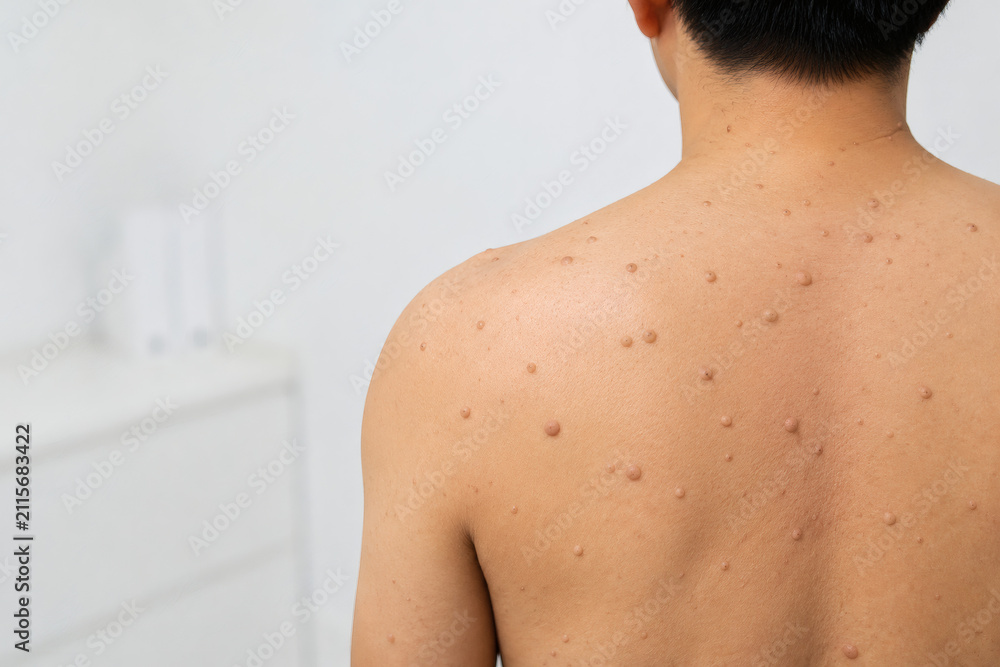 Naklejka premium Multiple Cutaneous Neurofibromas on Upper Back in Neurofibromatosis Type 1