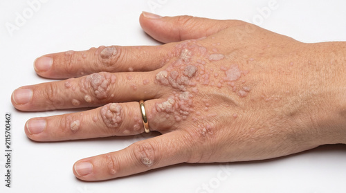 Adult Hand with Widespread Warts of Various Sizes on the Fingers and Knuckles - Polymorphic Verruca Vulgaris with Disseminated Papules and Hyperkeratotic Plaques on the Dorsal Hand and Phalanges