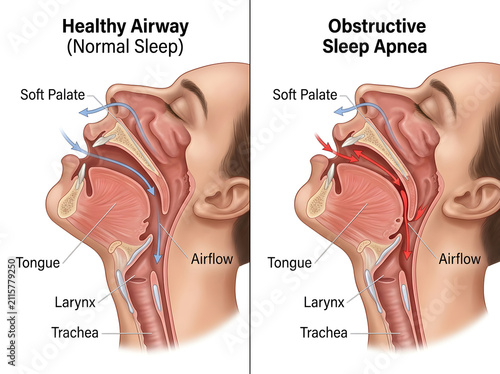 Healthy airway vs obstructive sleep apnea diagram illustration isolated on white background