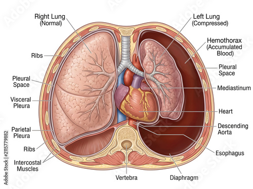 Human chest cross-section showing hemothorax and compressed lung isolated on white background