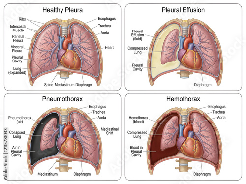 Medical illustration of healthy pleura and lung conditions comparison isolated on white background