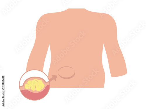 Lipoma Disease in Abdomen illustration