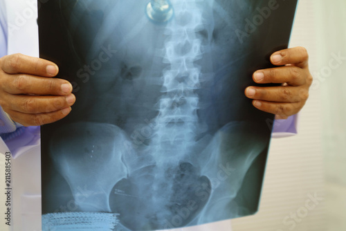 Foto Doctor examining spine bone radiography xray film.