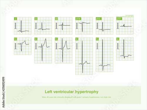 Fotografía Left ventricular hypertrophy is often accompanied by ST-T changes; these are cha