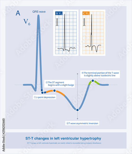 Foto The typical ST-T changes in left ventricular hypertrophy are a slight bulge at the beginning of the ST segment accompanied by downsloping depression and asymmetrical T wave inversion