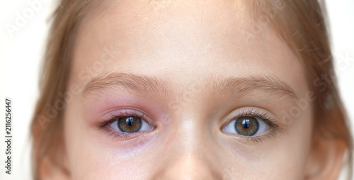 Bild auf Leinwand Close up of puffy child eye with barley