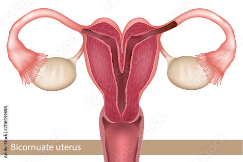 Bicornuate Uterus Congenital Uterine Malformation Medical Anatomy Cross Section Illustration. Female Reproductive System
