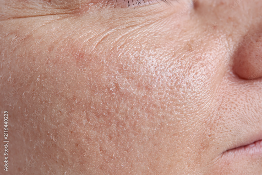 Fototapeta premium Dry facial skin with visible flakes and fine wrinkles on cheek close up, textured porous skin, natural complexion, slight redness, detailed macro skin surface