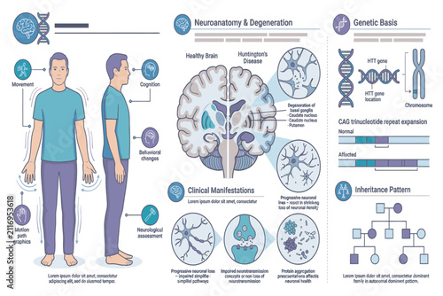Medical vector infographic presenting Huntington's Disease progression, neurological complications, genetic testing, and supportive healthcare information clearly.