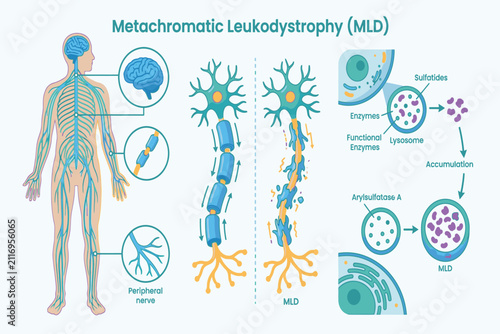 Educational Metachromatic leukodystrophy infographic featuring genetic mutations, myelin damage, clinical symptoms, diagnosis, and disease progression.