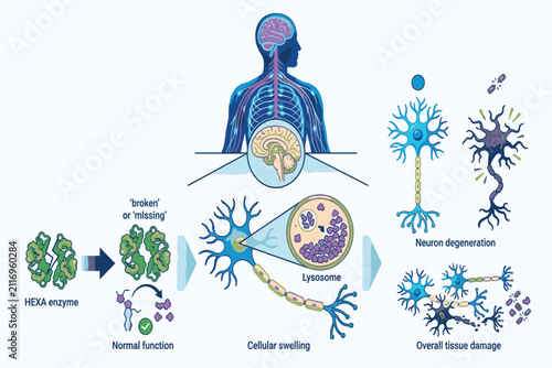 Tay-Sachs disease brain infographic illustrating neurodegeneration, genetic inheritance, diagnosis, and pediatric healthcare education effectively.