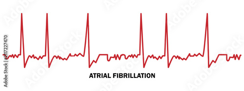Quadro su tela Medical illustration of atrial fibrillation heart rhythm on a clean white background display