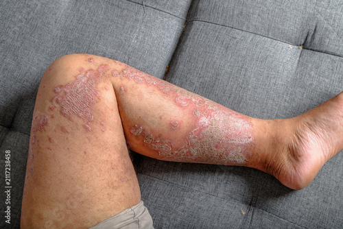 Cuadro en lienzo Close-up of inflamed dry scaly skin on a human leg, A chronic skin condition wit