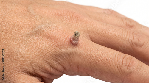 Quadro su tela Single pointed filiform wart protruding from the hand - Filiform Verruca Vulgari