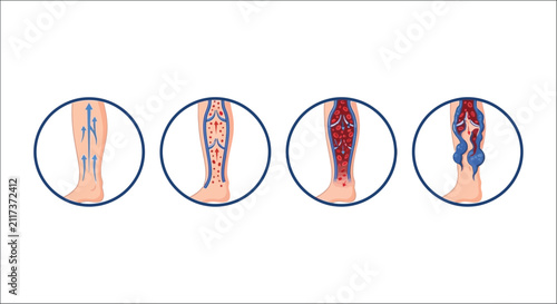 Bild auf Leinwand Stages Of Varicose Veins Progression Illustrated Vector Diagram With Human Leg A
