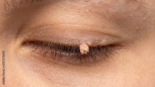 Fotografie Small frond-tipped filiform wart perched on the upper eyelid - Filiform Verruca
