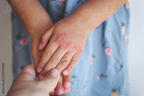 Child hand with visible eczema rash gently held by adult hand, closeup showing dry irritated skin, family support, pediatric dermatology, healthcare, allergy awareness, chronic skin condition concept