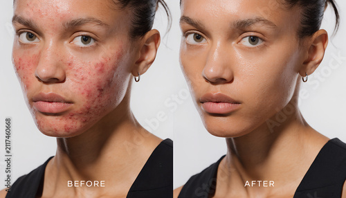 Split image of a Black woman's face, the left ('BEFORE') showing severe acne and inflammation, and the right ('AFTER') revealing smooth, clear, and radiant skin.