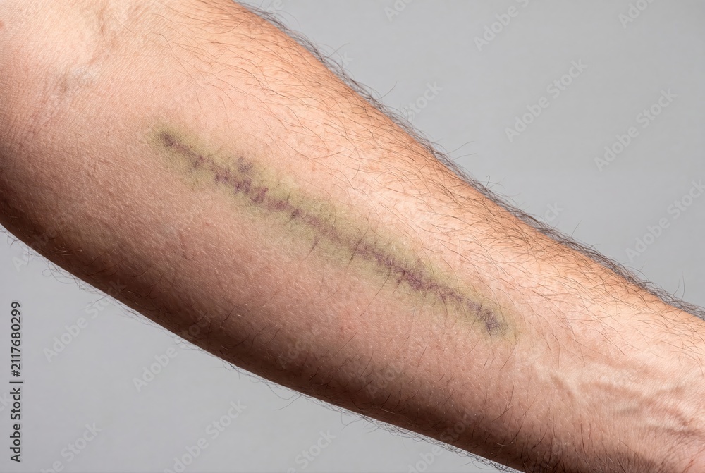 Fototapeta premium Surgical scar on human arm with bruising and healing skin texture
