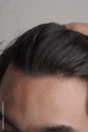 Obraz na plátně Close-up portrait of young man checking front hairline and scalp health
