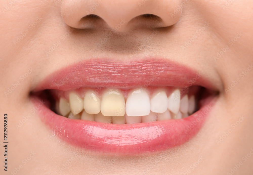 Obraz premium Woman before and after teeth whitening, closeup
