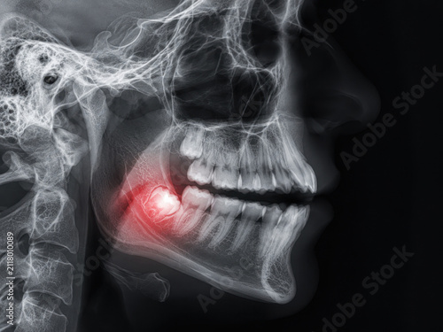 X-ray image of an impacted wisdom tooth with the inflamed area highlighted. Dental diagnosis, oral surgery and third molar extraction concept.