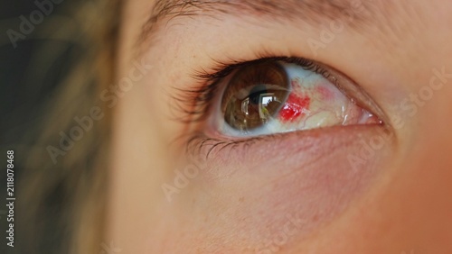 Photography Close-up of a human eye with a subconjunctival hemorrhage showing red blood vess