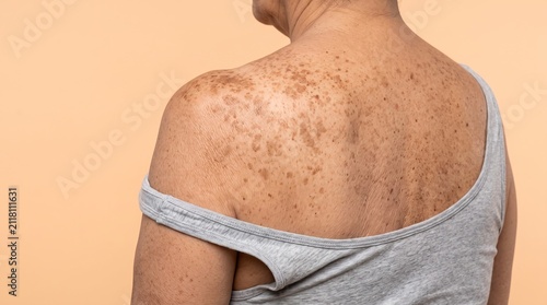 Back view of an senior person with age spots and hyperpigmentation sun damage on skin.