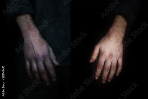 Paired hands showing rough bruised left and smooth healthy right background for duality health poster and healing concept design