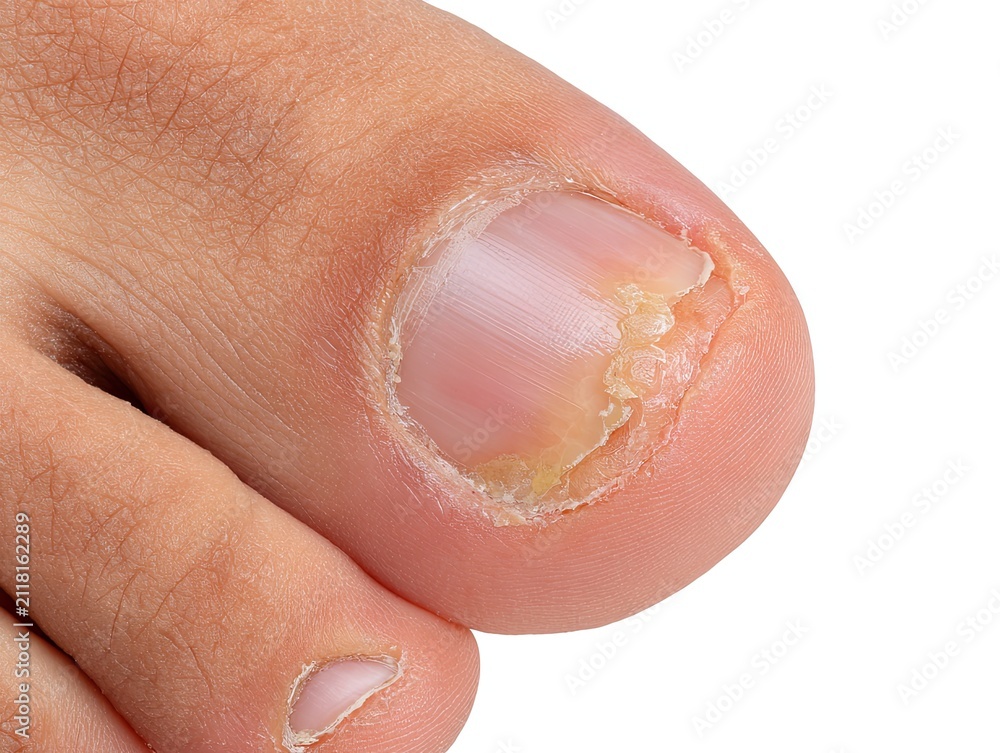Fototapeta premium Close‑up of toenail fungal infection, onychomycosis symptom, yellow thickened damaged nail, foot skin disease, medical clinical material on white background