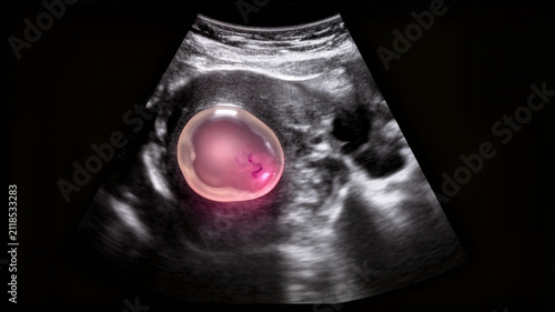 Cyst concept ,Ultrasound scan showing breast cyst with highlighted fluid filled sac, medical imaging for diagnosis
