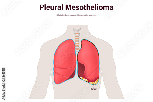 Pleural Mesothelioma. A rare cancer that grows in pleura. Human respiratory system.