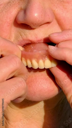dentures dentistry elderly woman removes and reinserts dental prosthesis while smiling naturally. The scene highlights oral health, modern dentistry, dental care and quality of life for seniors.