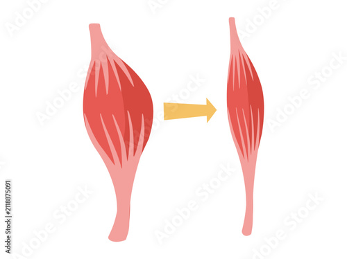 Normal Muscular and Dystrophy Atrophy