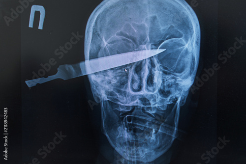 фотографія A close-up medical X-ray radiograph of a human skull with a large knife blade impaled inside, showing a severe head trauma, brain injury, stab wound, crime victim, or medical emergency