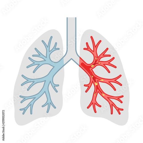 Photography Human lungs diagram showing healthy and inflamed bronchial tubes with mucus obst