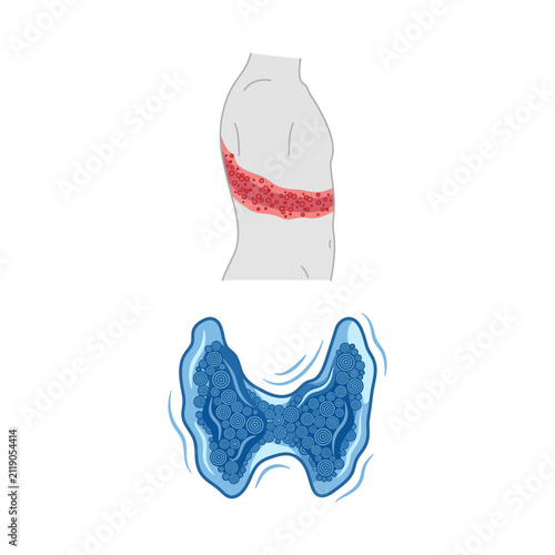 Canvas Print Medical illustration of shingles rash on the torso and an inflamed thyroid gland