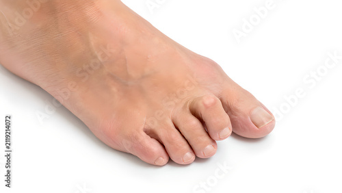 Hammer toe deformity in human toes, photorealistic medical 3D render showing flexed second toe anatomy on white background for podiatry, healthcare, medical education, and patient awareness use