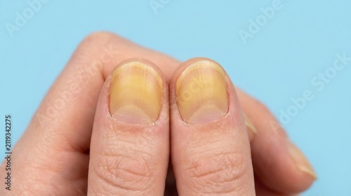 Close-up of human fingernails with yellow discoloration and thickening on a light blue background