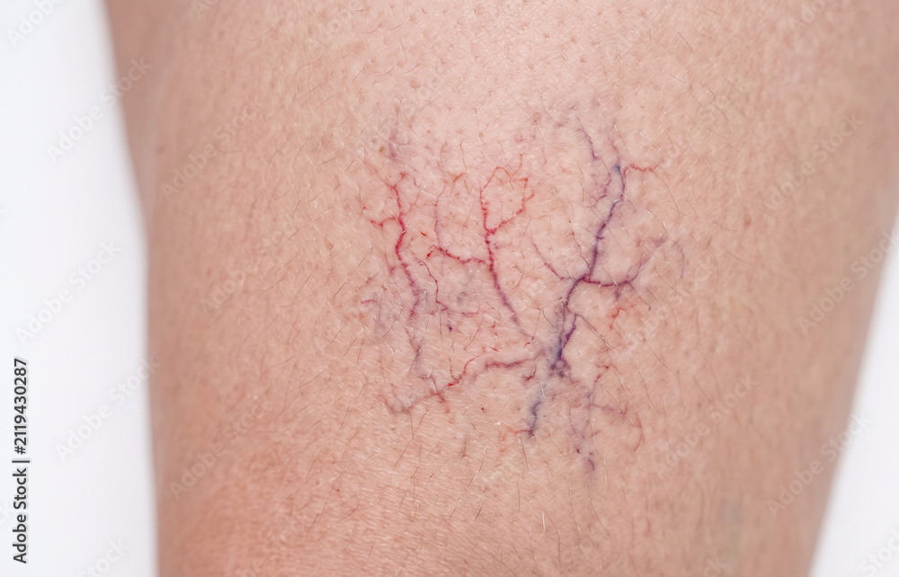 Fototapeta premium Spider Veins and Telangiectasia on Human Leg, Vascular Skin Condition Close Up