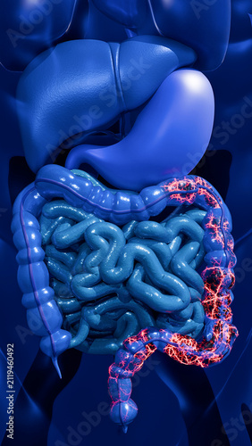 Human Large Intestine Anatomy with Advanced Colorectal Cancer Showing Tumor Development Along the Colon Wall Representing Digestive Disease and Clinical Oncology 3D Rendering