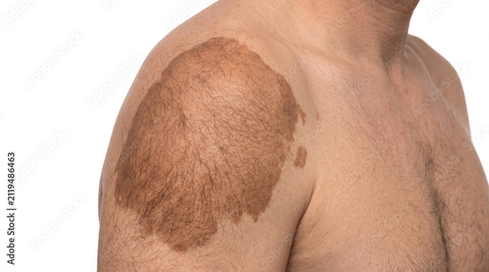 Naklejka premium Large hyperpigmented birthmark or nevus on male shoulder skin close-up