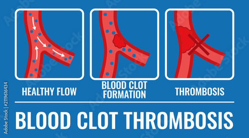 Fotografía Blood Clot Thrombosis Infographic Banner