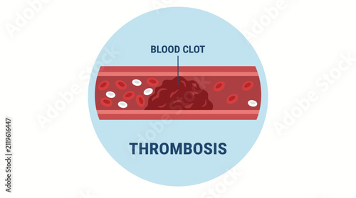 Quadro su tela Blood Clot Thrombosis Vector Illustration