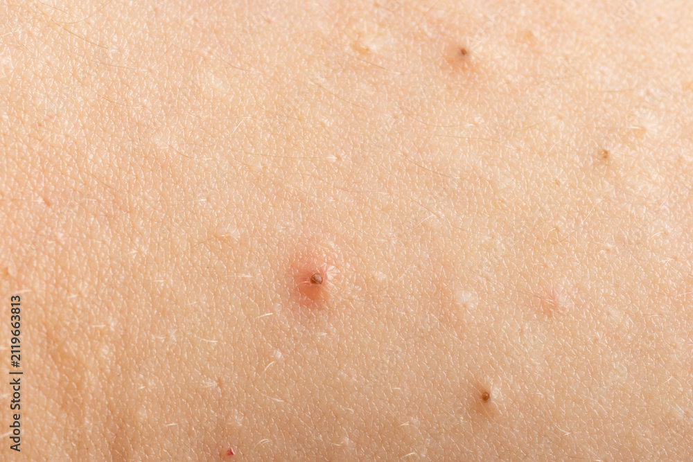 Fototapeta premium Close up epidermis with inflamed follicles and acne. Acne on skin closeup photo. Skin rash texture with acne. Irritated acne skin.