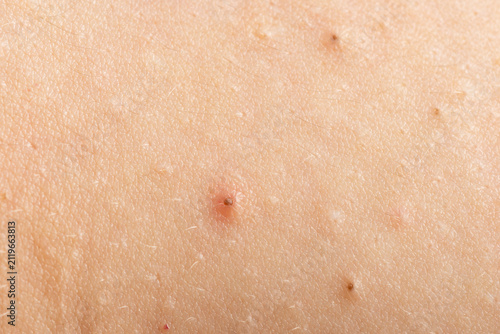 Foto Close up epidermis with inflamed follicles and acne
