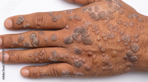 Cuadro en lienzo Severe Widespread Warts Covering the Back of a Hand - Severe Verruca Vulgaris wi