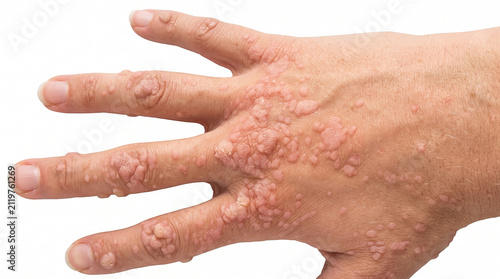 Fotografía Multiple Flesh-Colored Warts Papules with Mosaic Pattern on the Dorsal Hand