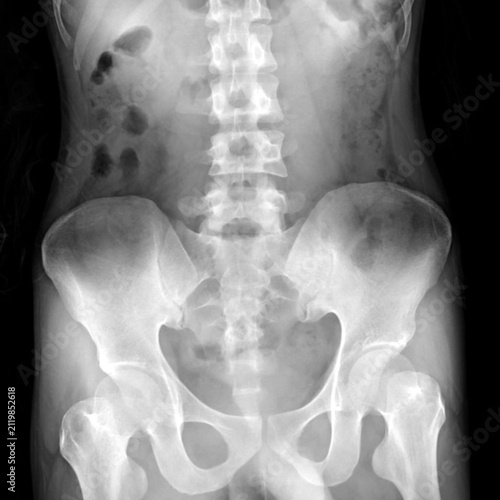 Photography Abdominal X-ray image of the human body for medical purposes