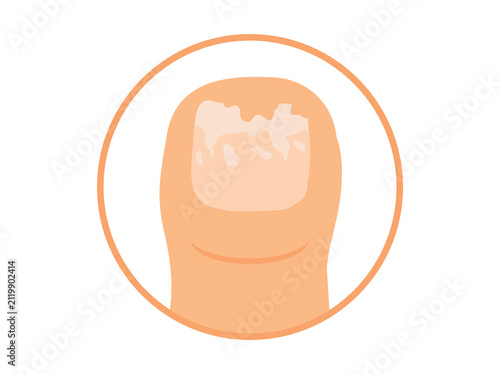 Brittle Nails Clip Art Illustration
